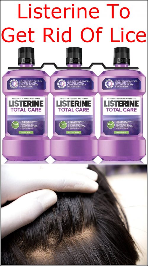 Listerine To Get Rid Of Lice | Listerine Foot Soak