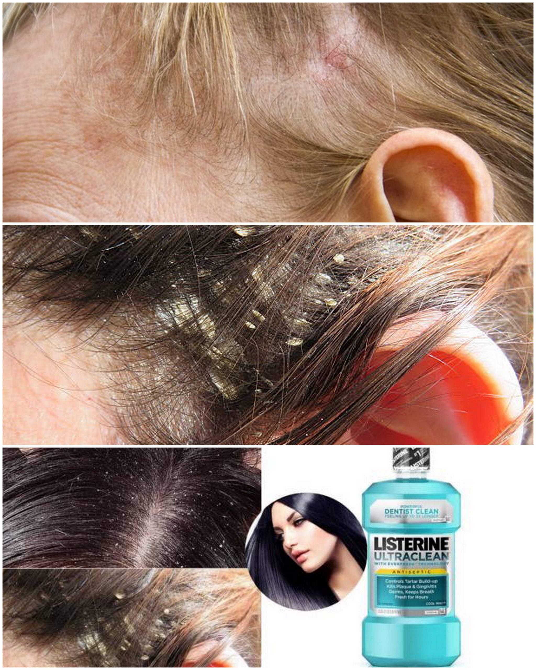 Listerine for Scalp Fungus | Listerine Foot Soak